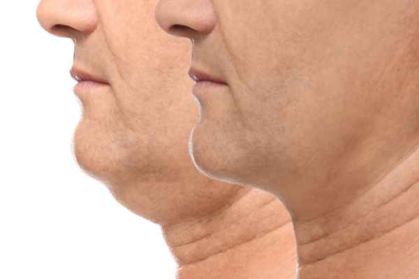 HIFU - Breakthrough in Anti - ageing 2 hifu results Royal Tunbridge Wells