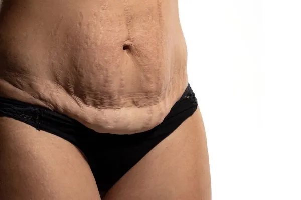 The science behind skin tightening Royal Tunbridge Wells picture of a woman's sagging skin on the stomach